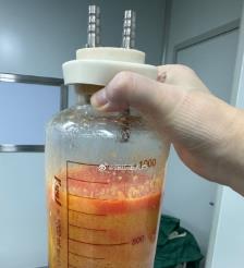 安顺水动力吸脂手术要做多久？